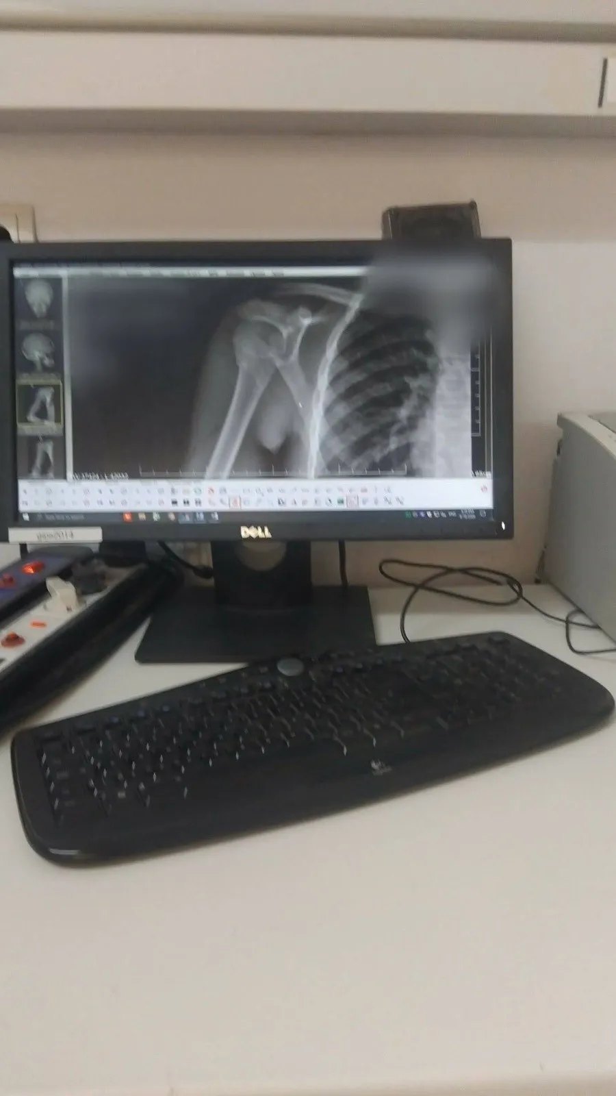 O radiografie a unui braț și a unor coaste este afișată pe un monitor de calculator de lângă un tastatură neagră.
