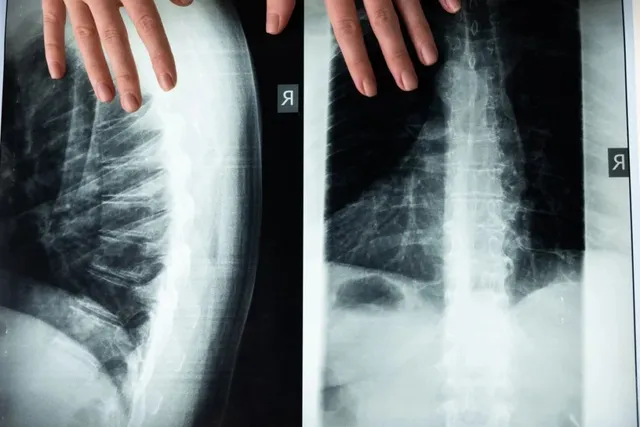 Două radiografii ale toracului, una prezentând o vedere laterală și cealaltă o vedere frontală, sunt afișate pe un fundal întunecat.