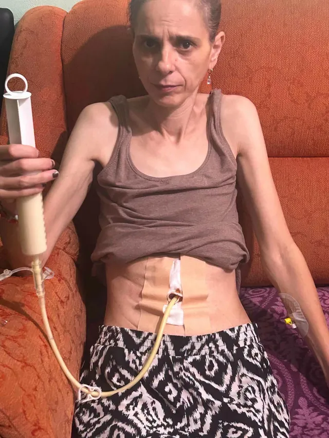 O femeie slabă stă pe o canapea portocalie, purtând un tricou maro și pantaloni cu model alb și negru, având un tub conectat la abdomen.