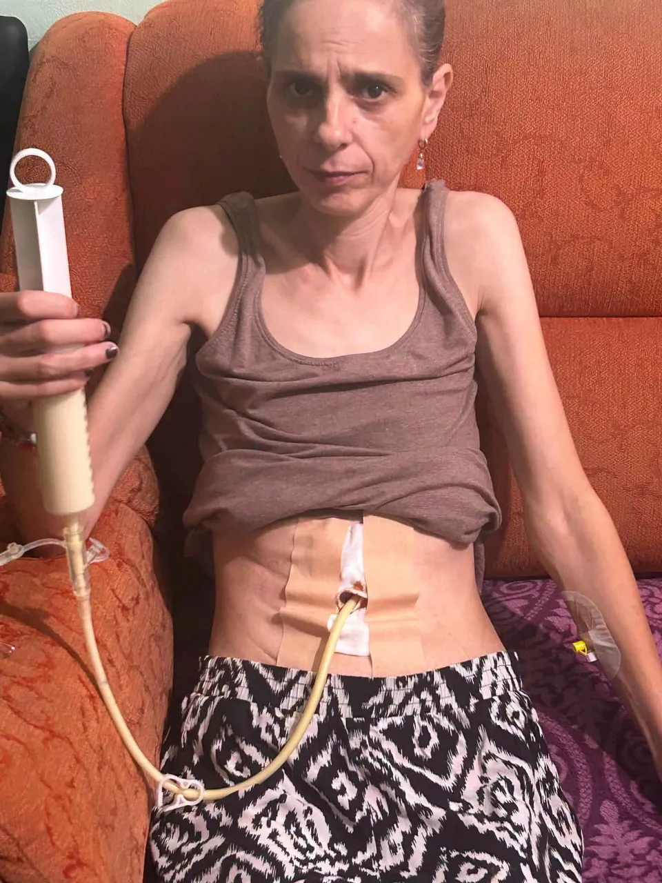 O femeie slabă stă pe o canapea portocalie, purtând un tricou maro și pantaloni cu model alb și negru, având un tub conectat la abdomen.