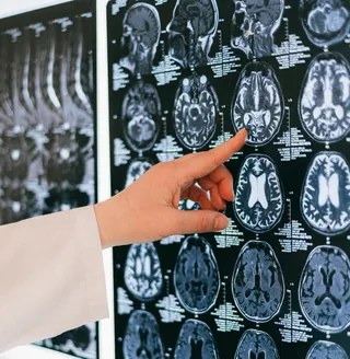 O mână într-o mânecă albă arată spre o serie de imagini de scanare cerebrală afișate pe un ecran negru.
