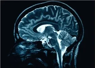 O imagine medicală de tip scanare MRI prezintă o secțiune sagitală a creierului uman pe un fundal întunecat.