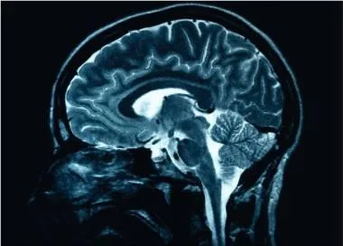 O imagine medicală de tip scanare MRI prezintă o secțiune sagitală a creierului uman pe un fundal întunecat.