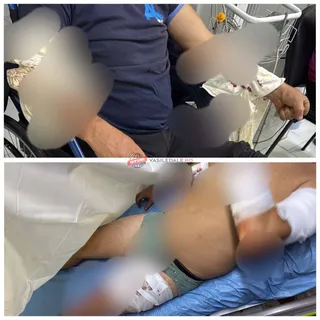 O persoană cu brațul și piciorul înfășurate în bandaje albe stă întinsă pe un pat de spital.
