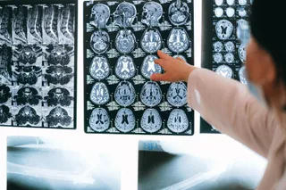 O persoană într-un halat alb indică spre o serie de imagini medicale de tip RMN care prezintă secțiuni transversale ale creierului uman.