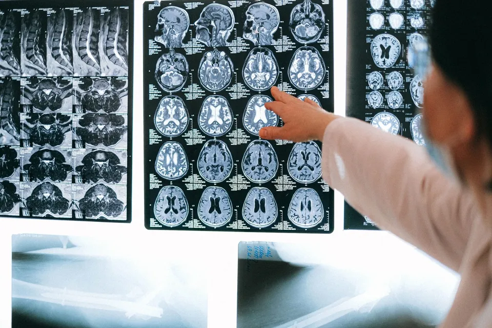 O persoană într-un halat alb indică spre o serie de imagini medicale de tip RMN care prezintă secțiuni transversale ale creierului uman.